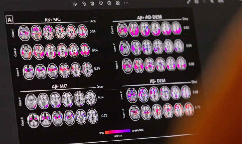 Alzheimer-Therapie : Was der Rückschlag in der Alzheimer-Therapie bedeutet