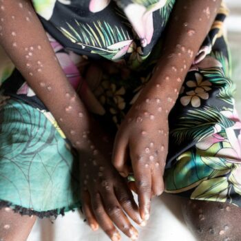 A suspected case of mpox. File pic: Reuters