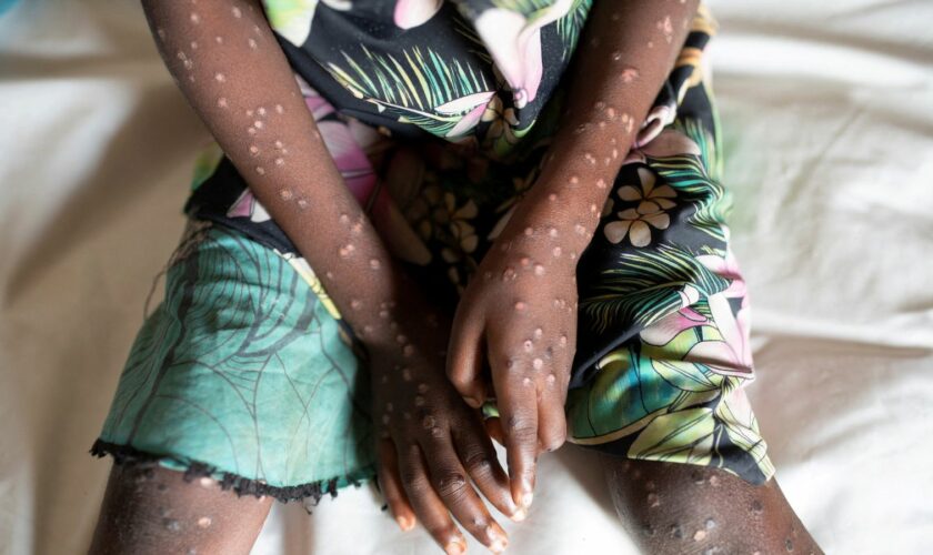 A suspected case of mpox. File pic: Reuters