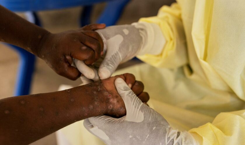 Afrika: WHO ruft wegen Mpox weltweite Notlage aus