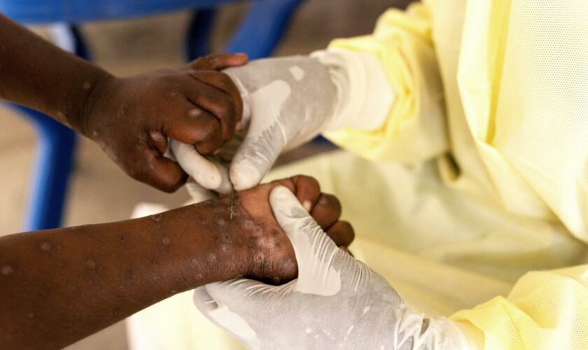 Viruskrankheit: WHO ruft wegen Mpox weltweite Notlage aus