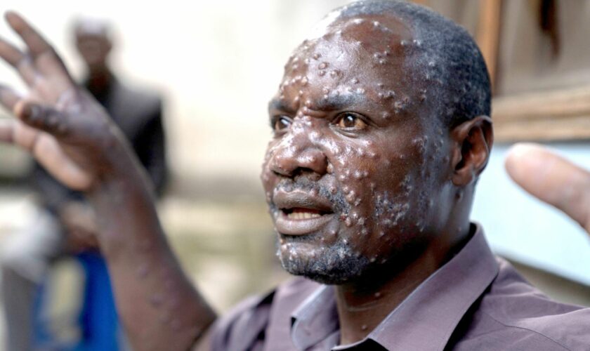 A man in the Democratic Republic of Congo has lesions on his face after contracting mpox in the latest outbreak. Pic: Reuters