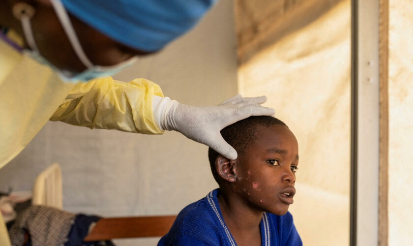 Épidémie de « mpox » 2024 en Afrique : pourquoi les scientifiques la jugent plus préoccupante que celle de 2022