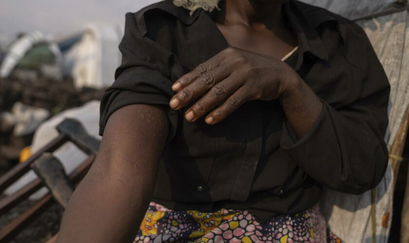 Mpox en Europe, typhon au Japon, «pogrom» en Cisjordanie… L’actu de ce vendredi 16 août matin