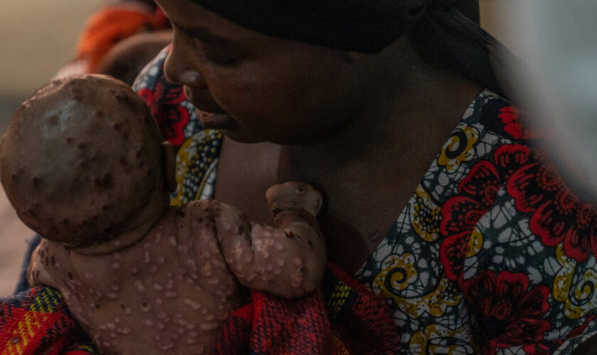 En Afrique, l’inquiétude autour des cas de mpox touchant les enfants