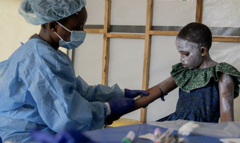 Mpox breitet sich zunehmend in Afrika aus