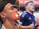 Man United star Rasmus Hojlund undergoes £1,400 laser acne treatment after his skin 'blew up'