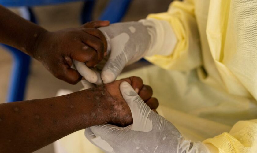 Mpox: le plus haut niveau d'alerte mondiale déclenché par l’OMS