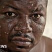 'My throat was so painful I couldn’t sleep' - on the mpox frontline