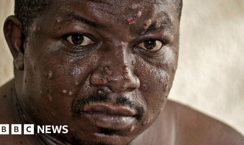 'My throat was so painful I couldn’t sleep' - on the mpox frontline