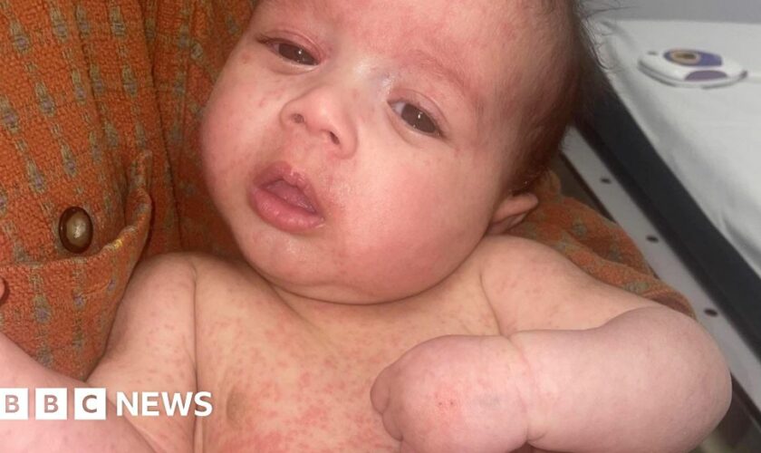 Parents warned of back-to-school measles surge