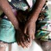 WHO declares Mpox global health emergency