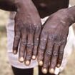 World Health Organization declares ultra-deadly monkeypox strain a public health emergency of international concern