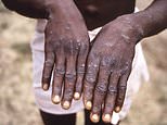 World Health Organization declares ultra-deadly monkeypox strain a public health emergency of international concern