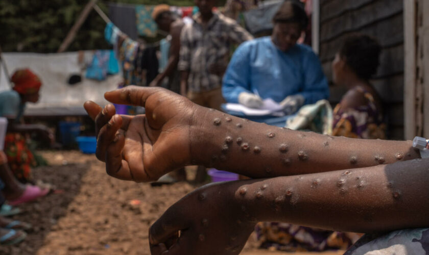 Mpox : épicentre de l'épidémie, la RD Congo reçoit ses premiers vaccins