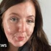 Acne fighter films her skin journey to help others