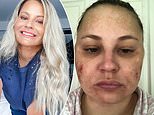 Cushing's disease: Ania was fit, healthy and just 31 when her face started to swell and break out in painful wounds that wouldn't heal