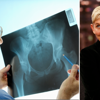 Ellen Degeneres has osteoporosis: Here's what to know about the painful bone condition