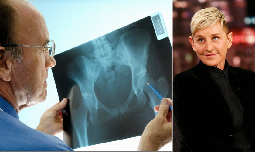 Ellen Degeneres has osteoporosis: Here's what to know about the painful bone condition