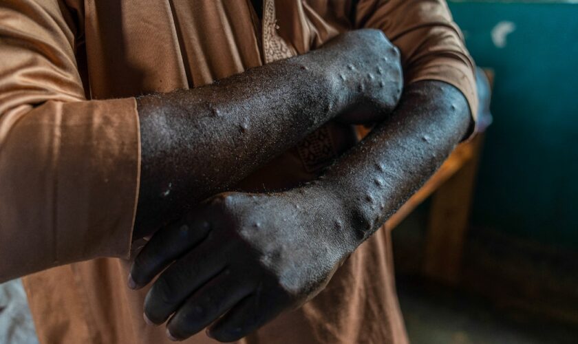 Un patient infecté par le mpox montre ses lésions dans un centre médical de Kamituga, dans l'est de la République démocratique du Congo, le 20 septembre 2024