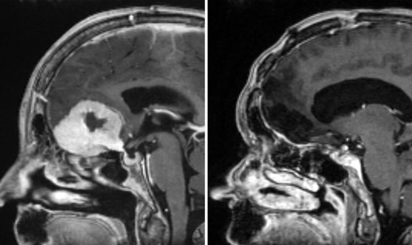 Scan of Doreen Adams head before (left) and after (right) an operation by consultant neurosurgeon, Anastasios Giamouriadis, to remove a brain tumour through her eyebrow. Pic: NHS Grampian