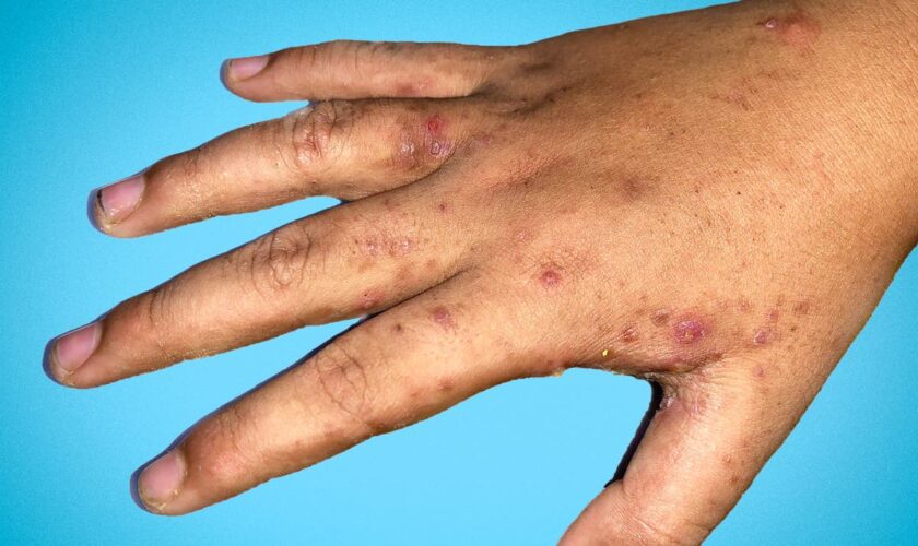 GPs report rise in scabies cases as public warned not to ignore potential symptoms