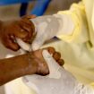 Christian Musema, a laboratory nurse, takes a sample from a child declared a suspected case of Mpox - an infectious disease caused by the monkeypox virus that sparks off a painful rash, enlarged lymph nodes and fever; at the treatment centre in Munigi, following Mpox cases in Nyiragongo territory near Goma, North Kivu province, Democratic Republic of the Congo July 19, 2024. REUTERS/Arlette Bashizi