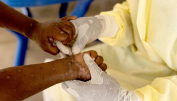 Christian Musema, a laboratory nurse, takes a sample from a child declared a suspected case of Mpox - an infectious disease caused by the monkeypox virus that sparks off a painful rash, enlarged lymph nodes and fever; at the treatment centre in Munigi, following Mpox cases in Nyiragongo territory near Goma, North Kivu province, Democratic Republic of the Congo July 19, 2024. REUTERS/Arlette Bashizi