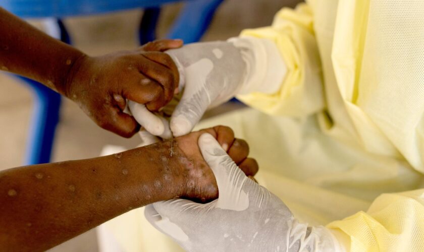 Christian Musema, a laboratory nurse, takes a sample from a child declared a suspected case of Mpox - an infectious disease caused by the monkeypox virus that sparks off a painful rash, enlarged lymph nodes and fever; at the treatment centre in Munigi, following Mpox cases in Nyiragongo territory near Goma, North Kivu province, Democratic Republic of the Congo July 19, 2024. REUTERS/Arlette Bashizi