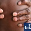 Skin checks helped reduce infections in Aboriginal children by half, study finds