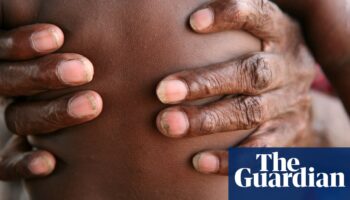 Skin checks helped reduce infections in Aboriginal children by half, study finds