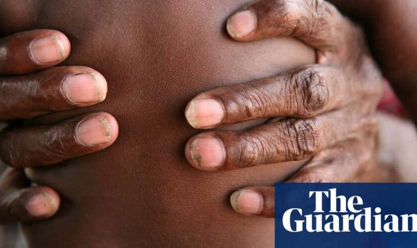 Skin checks helped reduce infections in Aboriginal children by half, study finds