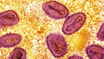 New case of mpox detected in UK