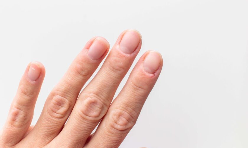 How to stop dry and cracked cuticles