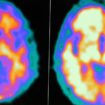 So funktioniert die jetzt zugelassene Alzheimer-Therapie