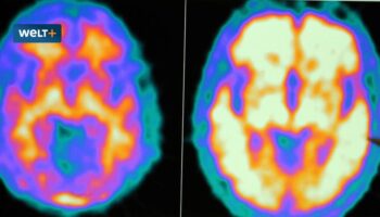 So funktioniert die jetzt zugelassene Alzheimer-Therapie