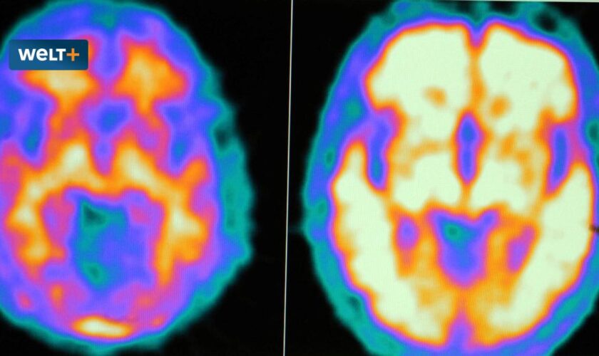 So funktioniert die jetzt zugelassene Alzheimer-Therapie