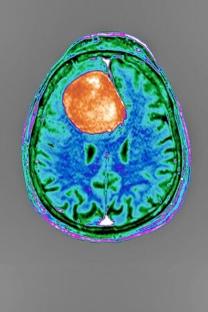 Hirntumore: Neue Methoden gegen den Krebs