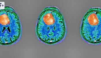 Hirntumore: Neue Methoden gegen den Krebs
