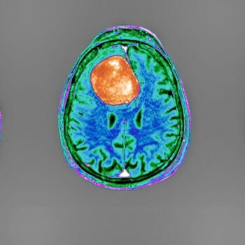 Hirntumore: Neue Methoden gegen den Krebs