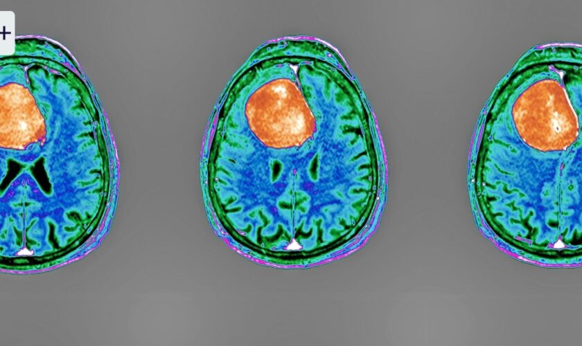 Hirntumore: Neue Methoden gegen den Krebs