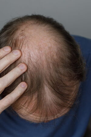 Ce traitement contre la perte de cheveux chez l'homme fonctionne mieux que les autres