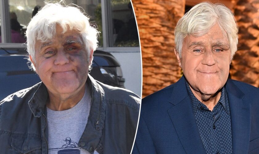 Jay Leno ‘feeling good’ despite suffering bruised face from fall