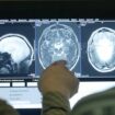 Alzheimer Medikament: EMA gibt grünes Licht für Lecanemab