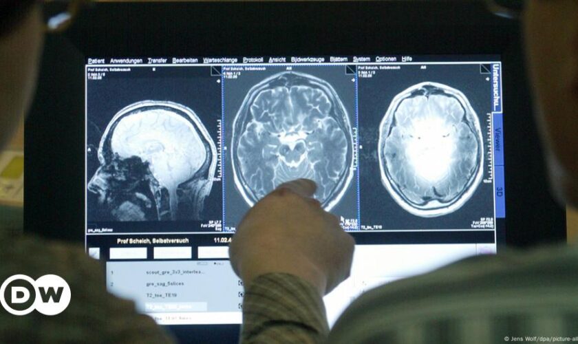 Alzheimer Medikament: EMA gibt grünes Licht für Lecanemab