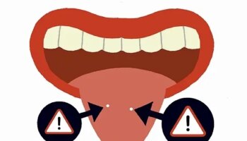 Halitosis, el mal olor de boca que afecta a uno de cada diez españoles