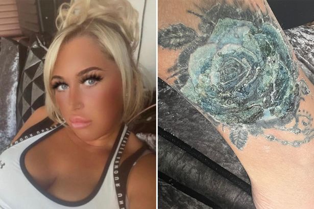 'Turkey holiday tattoo infection left me facing having my foot amputated'