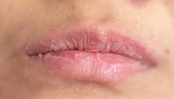 Dermatologist advises against two popular balms that can make dry lips worse