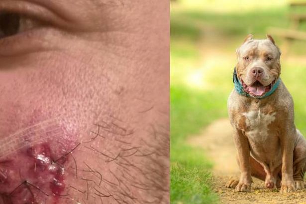 Man recounts terrifying attack by XL bully as police report dog is still on the loose