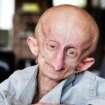 Muere a los 19 años la influencer Beandri Booysen, enferma de progeria